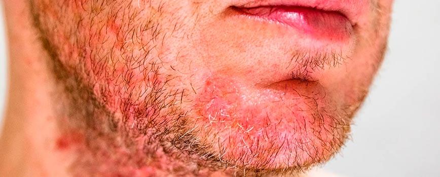 ¿Qué es la dermatitis seborreica en la barba?