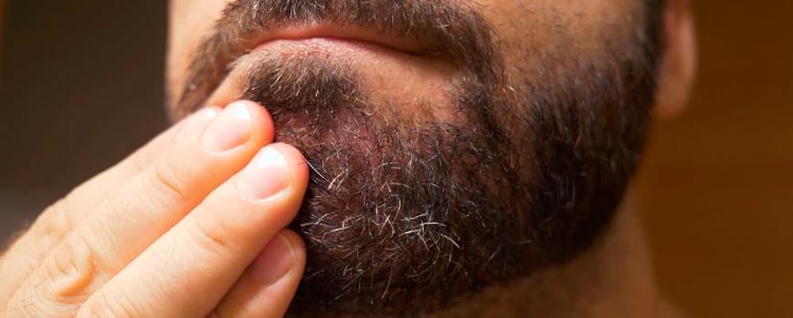 Causas de la dermatitis seborreica en la barba