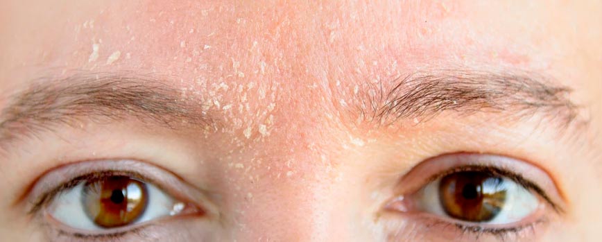 Antes de nada, ¿Qué es la dermatitis seborreica en las cejas?