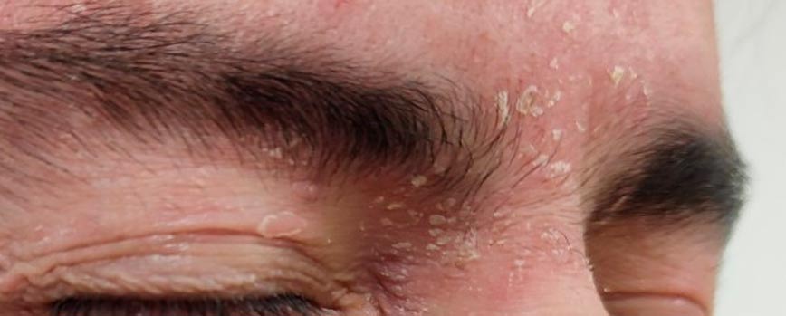 Causas de la dermatitis seborreica en las cejas más habituales
