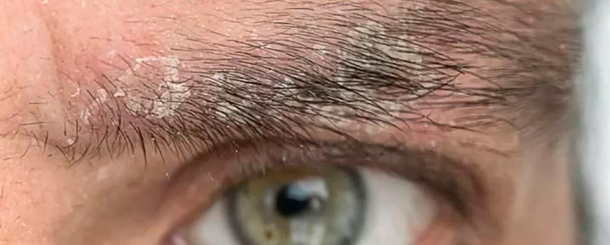 Síntomas de la dermatitis seborreica en las cejas