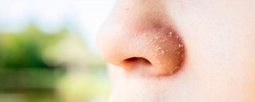 ¿Qué es la dermatitis seborreica en la nariz?