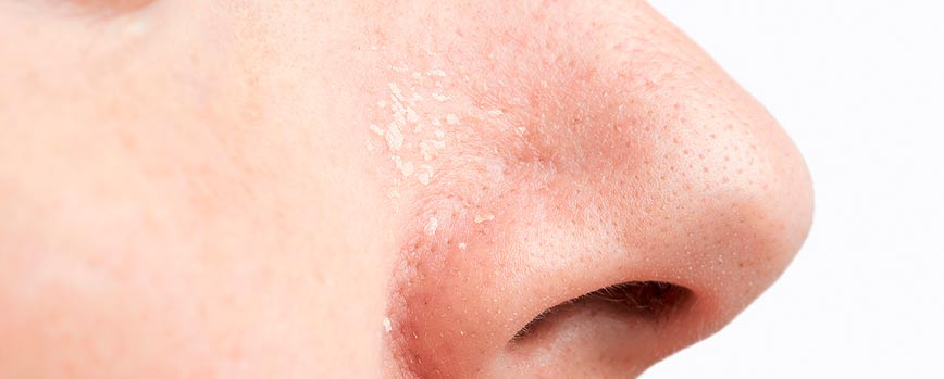 Síntomas de la dermatitis seborreica en la nariz