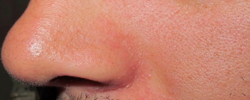 Causas de la dermatitis seborreica en la nariz