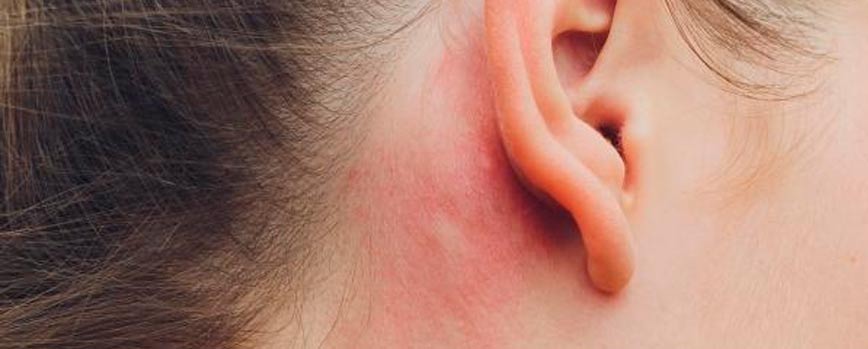 Diferentes formas de dermatitis seborreica en las orejas