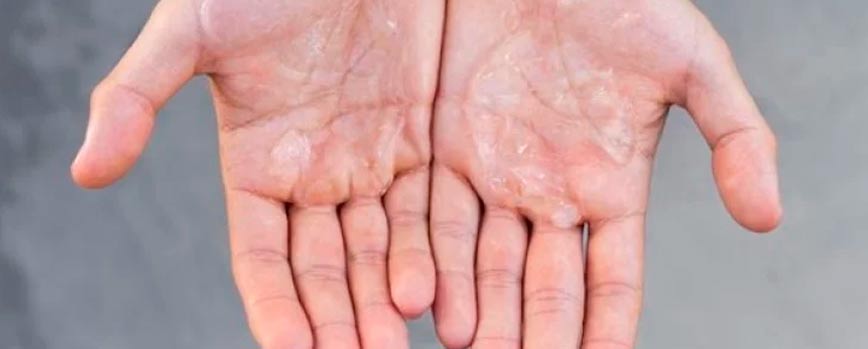 Causas de la dishidrosis en las manos
