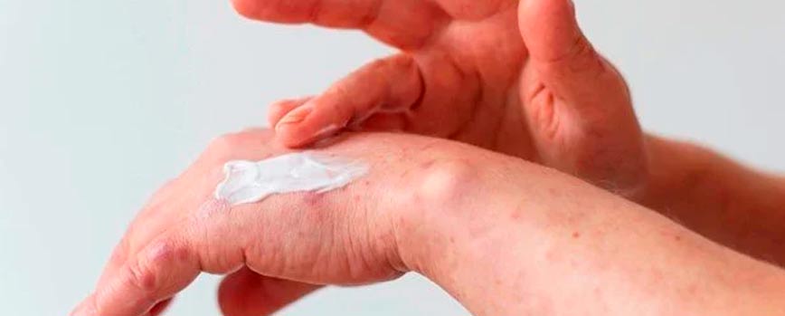 Tratamiento de la dishidrosis en las manos