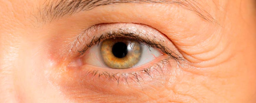¿Por qué salen las patas de gallo en los ojos?