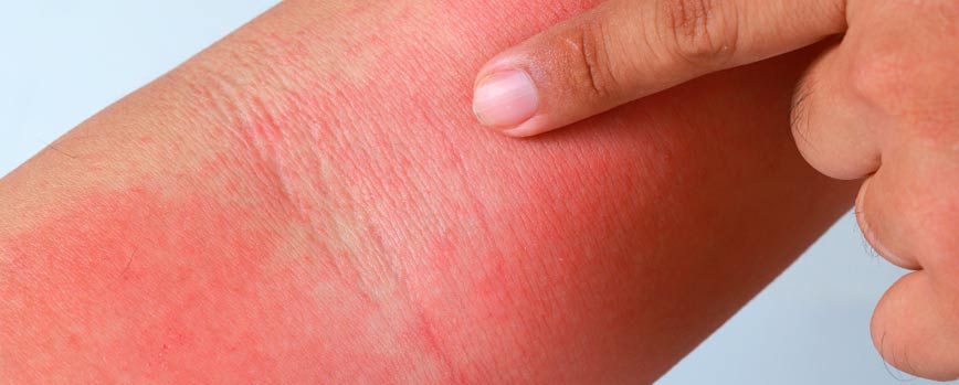 ¿Qué es la xerosis?