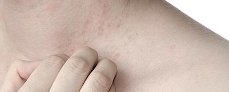 ¿Qué provoca la xerosis?