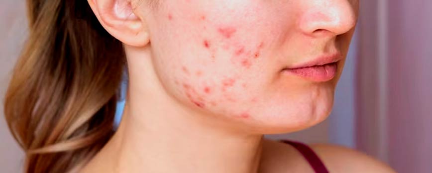 Causas del acné hormonal