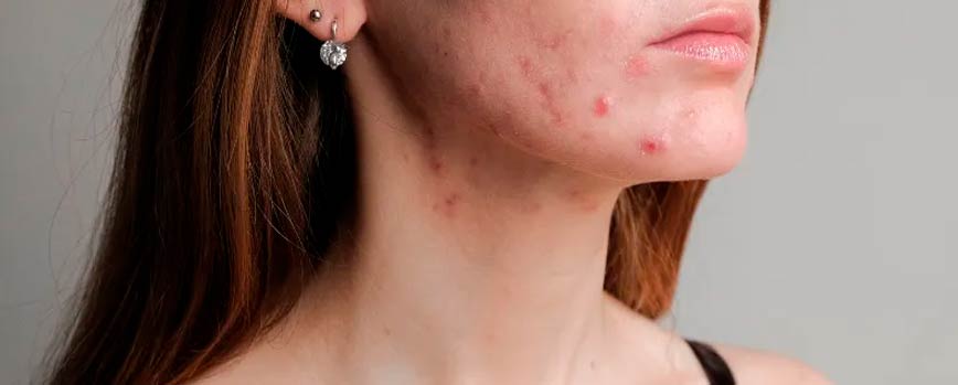 ¿Cómo las hormonas causan acné?