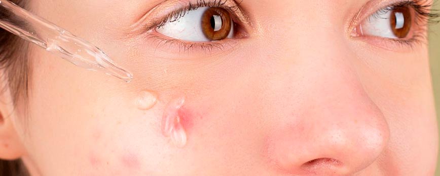 Tratamiento para el acné hormonal