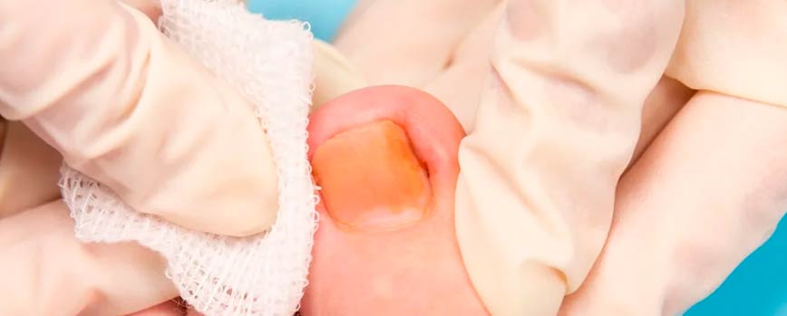 Productos recomendados para uñeros infectados