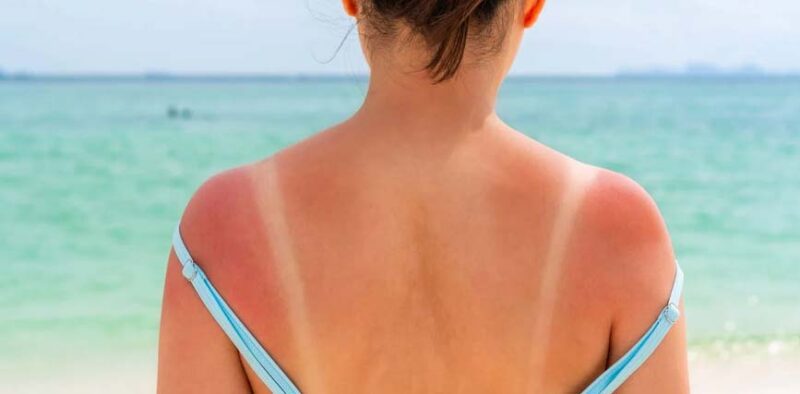 Calos Solar Callo Solar: ¿Qué es, Cómo Identificarlo y Proteger tu Piel del Sol ...