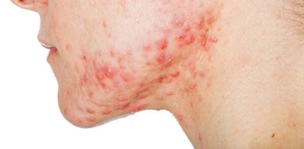 Pústulas: ¿qué son y cómo curarlas? | Blog Druni