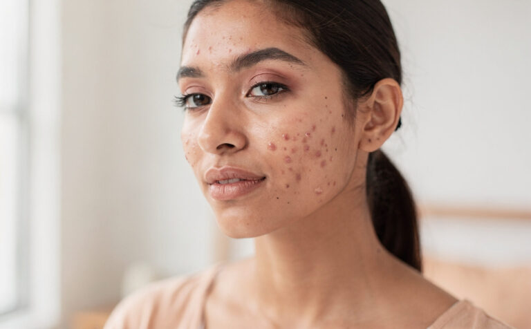 mujer joven con acne en la cara sutil pequeños granitos