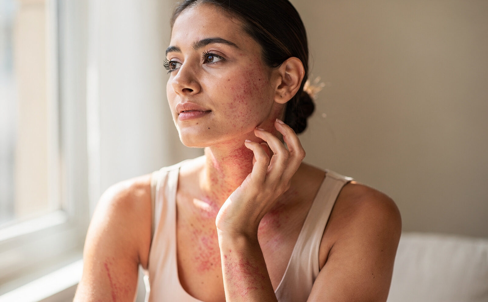 mujer con la piel del cuello y brazo irritada y roja. no muy irritada