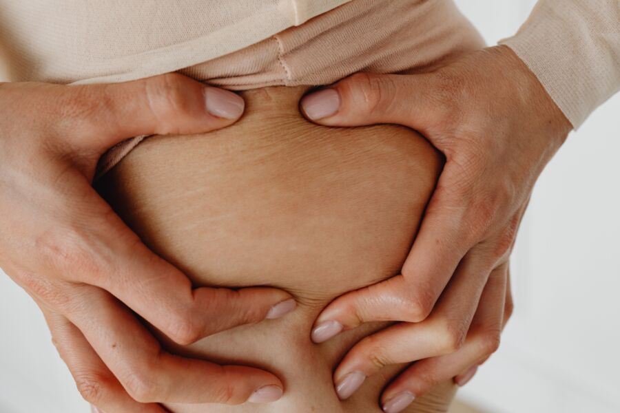 Un primer plano detallado que muestra las manos de una mujer sosteniendo su piel, centrándose en las estrías.