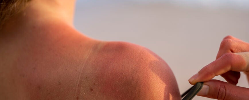 Detalles de la piel quemada por el sol de una mujer del sol de la playa