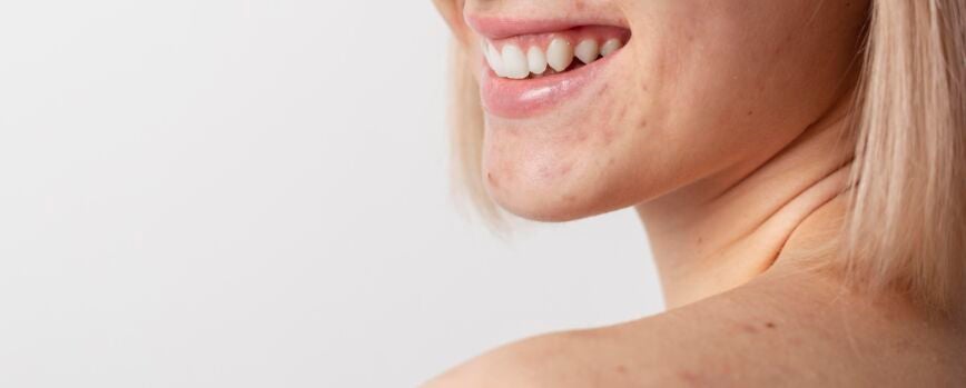Cerrar modelo sonriente con acné