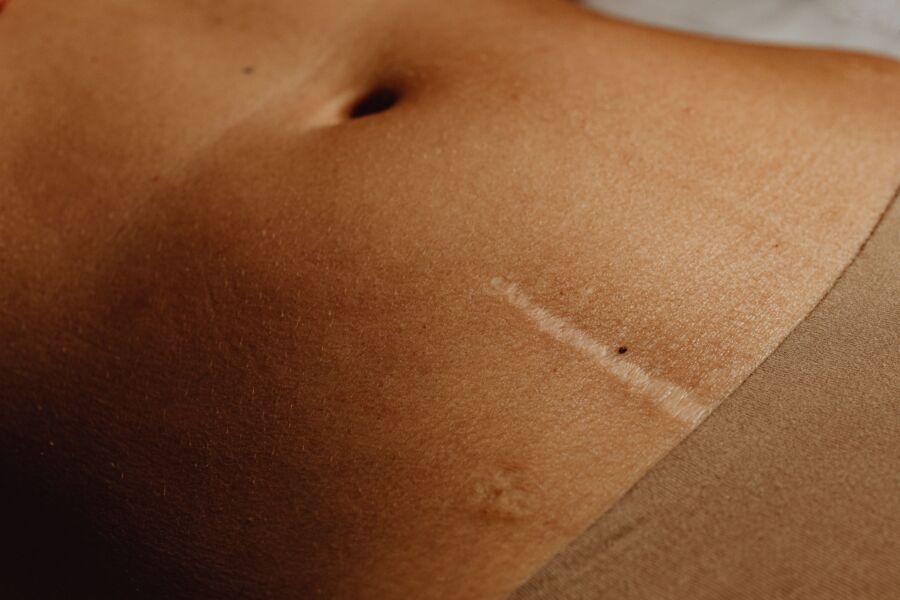 Primer plano detallado del abdomen de una mujer que muestra una cicatriz y lunares, destacando la textura de la piel.