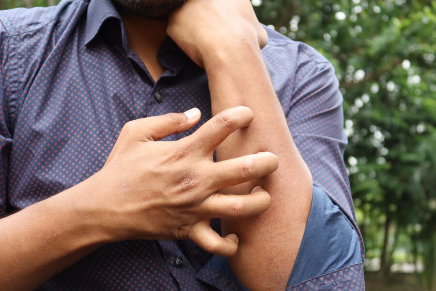 Un hombre con una camisa azul rascándose el brazo al aire libre, destacando la irritación de la piel.