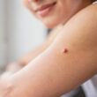 persona con pequeña picadura de mosquito en el brazo