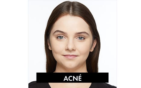 Producto categoria acné